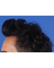 After Hair Transplant&nbsp;Front